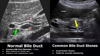 Bile Duct Ultrasound Normal Vs Abnormal Image Appearances | Biliary Tract Abnormalities USG Scan