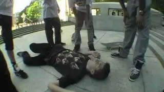 Skateboard Fall- Concussion