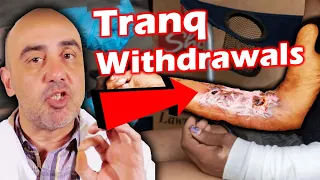 Tranq Dope Withdrawal Symptoms: The Dangerous Truth