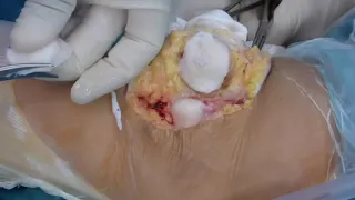 Fresh Osteochondral Patellar Allograft Resurfacing