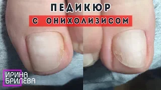 PEDICURE and Onycholysis 🆘 Exfoliation and Emptiness under the nail (English SUBTITLES)