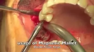 Implatech Magnetic Mallet Osteotom Sistemi - Video 2