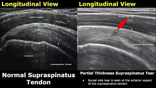 Shoulder Ultrasound Normal Vs Abnormal Image Appearances | Sports Injuries | Musculoskeletal USG