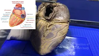 Blood supply of heart or Coronary circulation - Gross and clinical anatomy