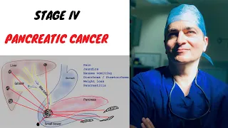 Pancreatic Cancer Stage 4