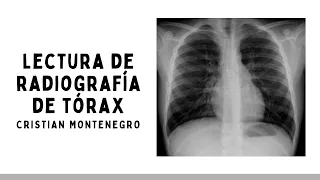 LECTURA DE RADIOGRAFÍA DE TÓRAX: Principales Patologías | Semiología