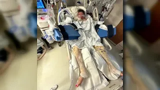 'A big boom:' TikTok challenge leaves Wake Forest teen with burns on nearly 80% of his body