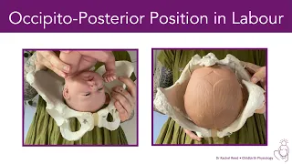 Occipito-Posterior Position (Back-to-Back) in Labour