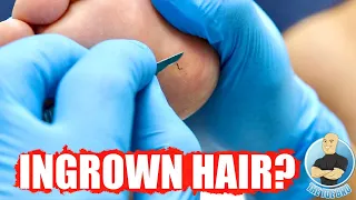 INGROWN HAIR GROWING OUT OF HER FOOT?!