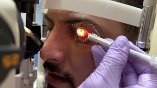 Removal of Metal Embedded in Cornea