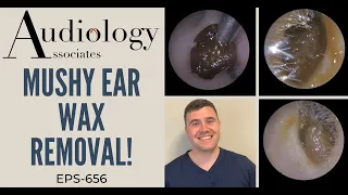 MUSHY EAR WAX REMOVAL - EP656