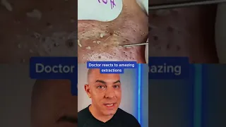 Doctor reacts to an amazing pimple extraction! #pimplepop #skinextraction #satisfying #dermreacts