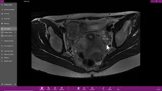 Anatomia radiológica do ovário