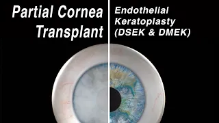 Selective Cornea Transplant - Endothelial Keratoplasty (DMEK, DSEK)