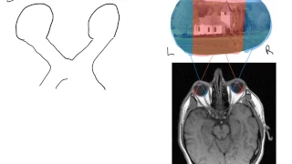 Bitemporal hemianopia 1