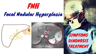 FNH Liver | Focal Nodular Hyperplasia Liver
