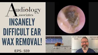 INSANELY DIFFICULT EAR WAX REMOVAL - EP559