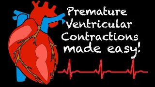 EMS Cardiology || Tachy Tuesday: Premature Ventricular Contractions (PVC)