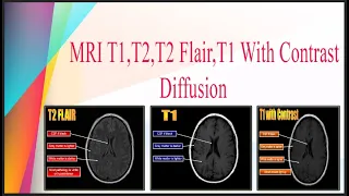 MRI T1,T2,T2 Flair,diffusion