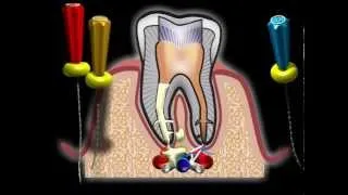 Осложнения при лечении корня зуба
