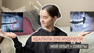 УДАЛИЛА ЗУБ МУДРОСТИ | КАК ПРОШЛО И РЕКОМЕНДАЦИИ