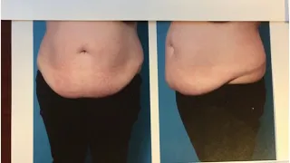 Hanging Skin Removed with a Tummy Tuck