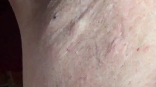 Acne in the armpits| 06/02/2020