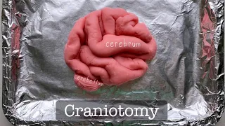 Playdough Surgery - Craniotomy and Meningioma (Brain Tumor) Removal