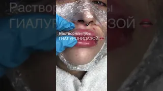 Шок!!!!  шарики в губах !!!! После увеличения губ