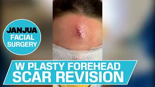 W PLASTY FOREHEAD SCAR REVISION - DR. TANVEER JANJUA - NEW JERSEY