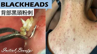 擠粉刺 痘痘 背部黑頭粉刺(blackheads on back) - Taiwan Tainan台南清粉刺最乾淨 （珂萊兒spa 婕芸）