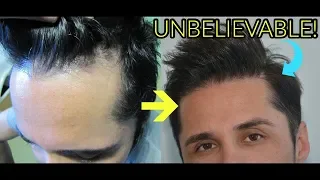 TOP 3 HAIR TRANSPLANT DOCTORS IN TURKEY! MUST WATCH!