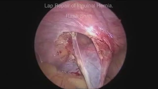 Laparoscopic Hernia repair in a child by Dr. Rasik Shah