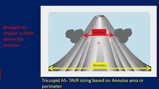 Updates on TAVR for Bicuspid Aortic Stenosis in 2022 | Yashasvi Chugh, MD