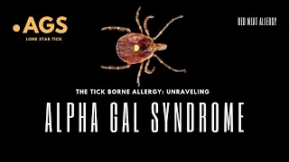 The Tick Borne Allergy: Unraveling Alpha Gal Syndrome