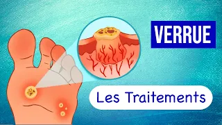 Verrues : Les Traitements pour les Soigner