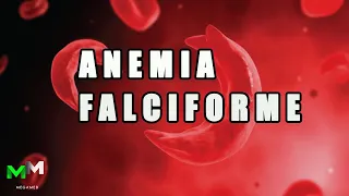 Anemia Falciforme