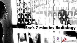 Sav's 7-minute snippets- Pediatric TB- Clues from the Frontal chest radiograph