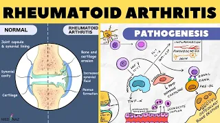 Rheumatoid Arthritis Pathophysiology / Rheumatoid Arthritis Pathogenesis / Arthritis pathophysiology