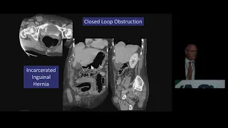 CT Bowel Obstruction: What Really Matters? | Free Radiology CME