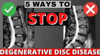 5 Ways To Stop or Delay Degenerative Disc Disease