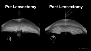 Clear Lens Extraction for Angle Closure Glaucoma Ike Ahmed Lecture 2022