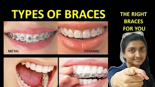 Types of braces -pros and cons|best braces for teeth