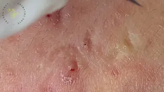 SAC DEP SPA Blackheads | #780