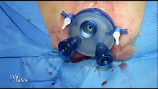 Rimozione in laparoscopia delle neoplasie del retto