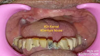 #Denture house #Dr Kamal # Single complete denture