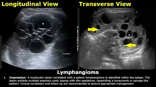 Spleen Ultrasound Reporting | Splenic Disease Scan Reports | How To Write USG Report | Abdominal USG