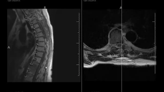 How to differentiate Degenerative disk disease and spinal infection.