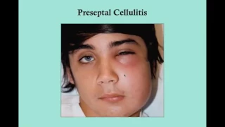 Preseptal and Orbital Cellulitis   CRASH! USMLE Step 2 and 3‬