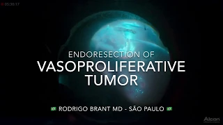 Endoresection of a Retinal Vasoproliferative Tumor